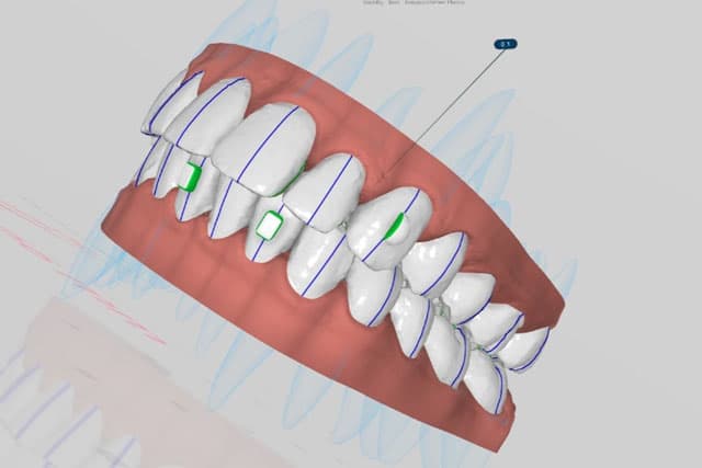 AlineáVOS! Diseño y producción in-office de alineadores dentales [Nueva edición]