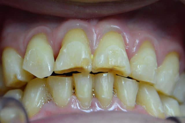Desgastes Dentales: Diagnóstico y alternativas de tratamiento – Segunda edición