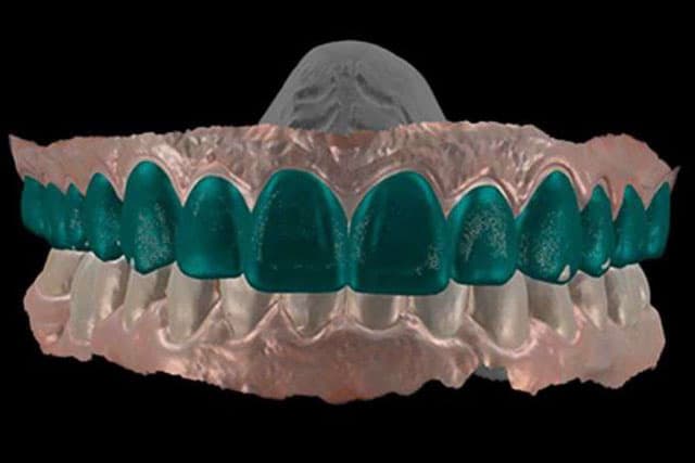Estética Digital: carillas de resinas compuestas