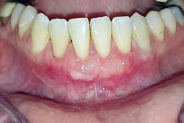 Cirugía periodontal en dientes e implantes