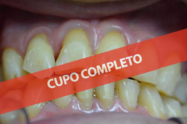 Desgastes Dentales: Diagnóstico y alternativas de tratamiento – Segunda edición