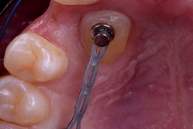 Microimplantes en Ortodoncia