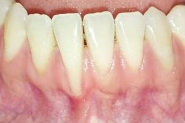 Manejo de tejidos blandos y reconstrucción gingival en dientes e implantes – FULL DAY HANDS-ON