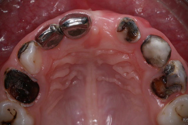 Curso Intensivo de coronas estéticas en niños (CoronHadas)