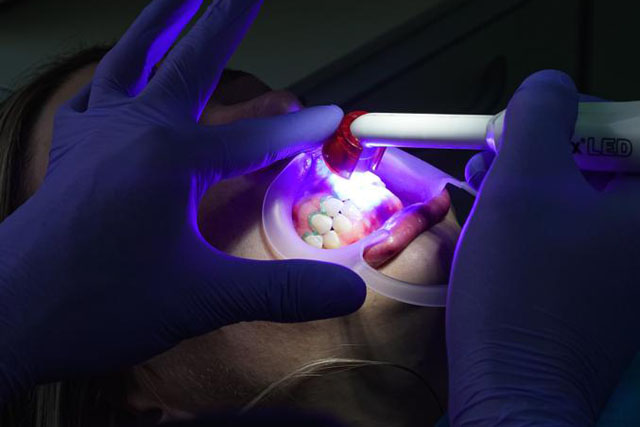 Estética Dental Mínimamente Invasiva: Todo sobre Blanqueamientos y Microabrasión