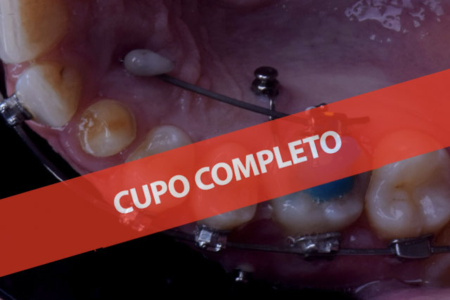 Microimplantes 2D y 3D